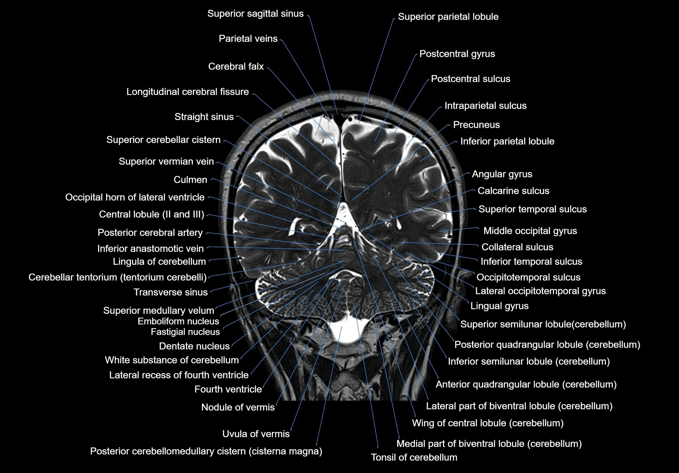 MRI Brain coronal cross sectional labelled anatomy 3T image  -img-00001-00053.webp